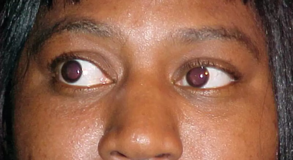 تیروئید چشمی چه علائمی دارد